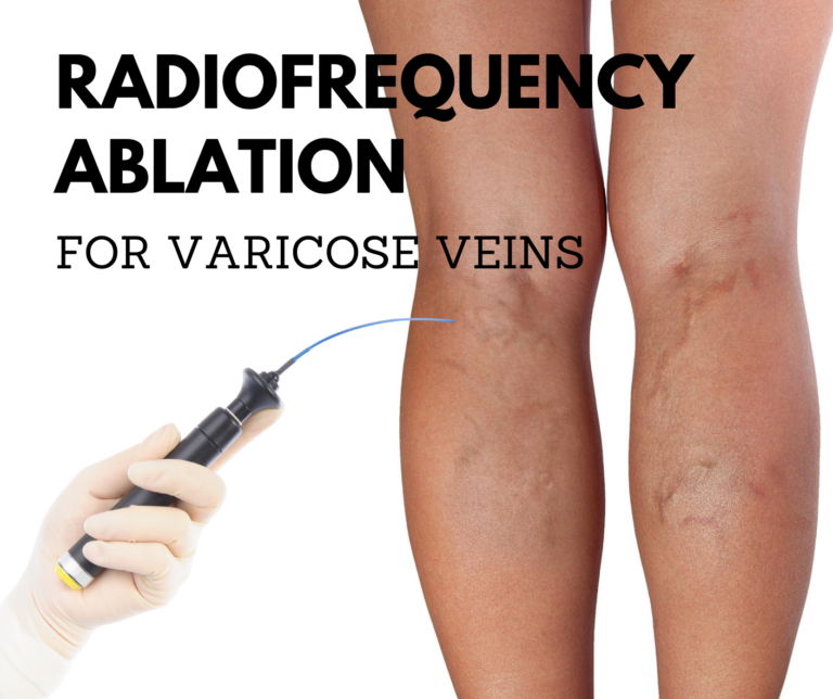 Radiofrequency Ablation For Varicose Veins - Elite Vein Clinic