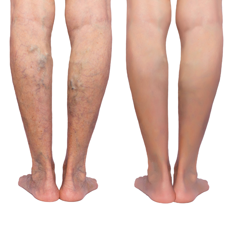 How long does it take to recover from varicose vein treatment