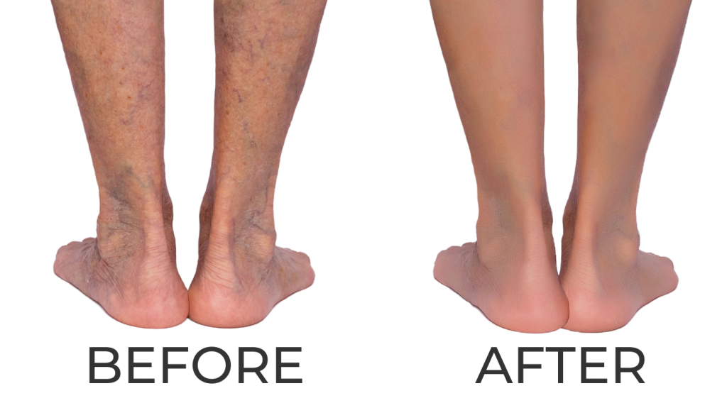 Varicose Veins Treatment Beverly Hills