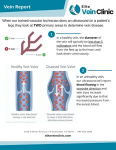 Top 3 Signs of Vein Disease You Should Know