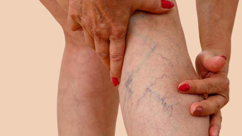 How Effective Is Compression Therapy for Vein