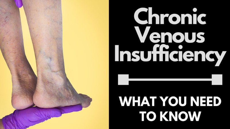 Chronic Venous Insufficiency - Ivein Clinic