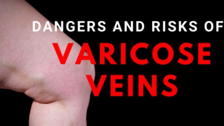 5 Hidden Dangers Of Varicose Veins Elite Vein Clinic 