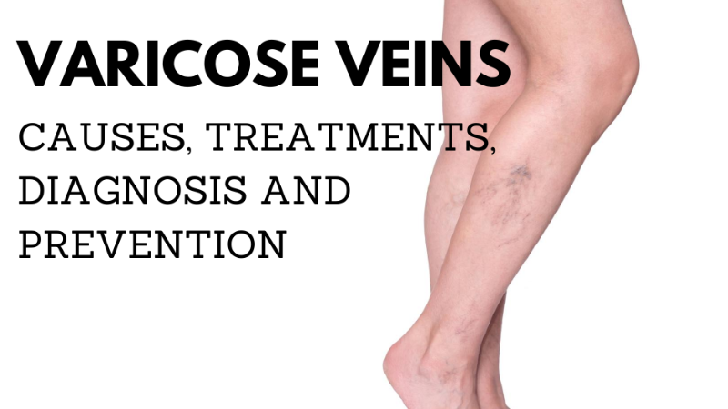 Varicose Veins: Causes, Treatment, Diagnosis, and Prevention