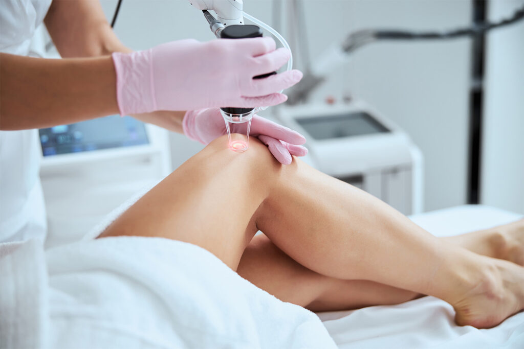 laser vein treatment