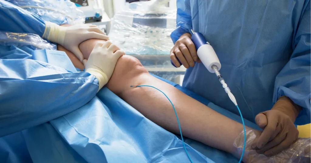 VenaSeal Treatment for Varicose Veins